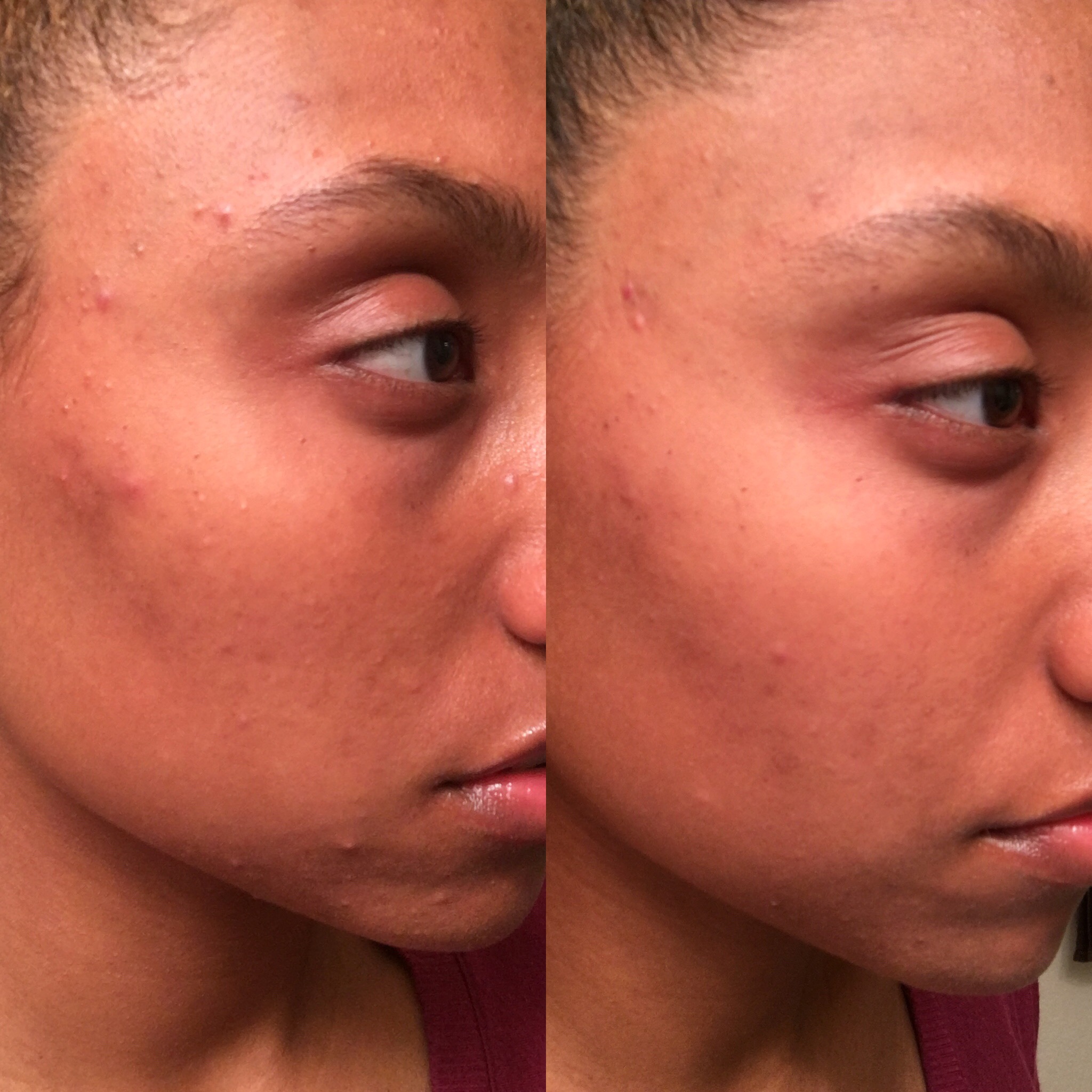 before and after using Kiehl's Blue Herbal Treatment Acne Cleanser